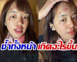 เเฟนๆห่วง พลอยไพลิน หน้าช้ำหลังกลับจากทริปแอนตาร์กติกา