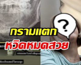 เห็นแล้วเจ็บแทน! ดาราสาวดัง กรามแตก หลังโดนหวดเข้าหน้า