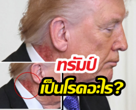 โซเชียลแห่แชร์ ทรัมป์เป็นโรคอะไร?มีแผลผื่นแดงหนารอบลำคอ