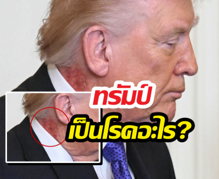 โซเชียลแห่แชร์ ทรัมป์เป็นโรคอะไร?มีแผลผื่นแดงหนารอบลำคอ