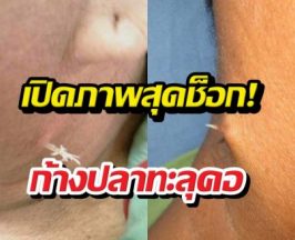 เห็นแล้วต้องขนลุก!ก้างติดคออย่าปล่อยไว้นาน อันตรายมาก!