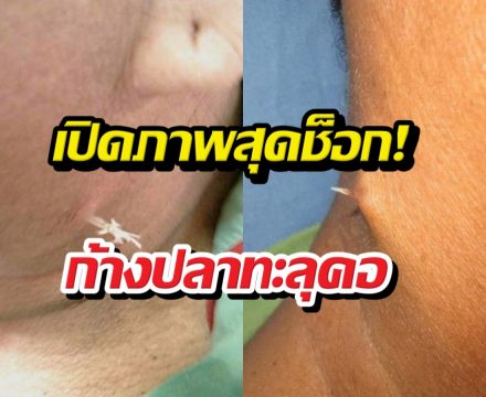 เห็นแล้วต้องขนลุก!ก้างติดคออย่าปล่อยไว้นาน อันตรายมาก!