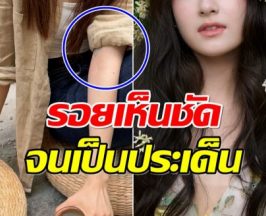 ชาวเน็ตดราม่า! รอยที่แขนนางเอกดัง กลายเป็นประเด็นร้อน