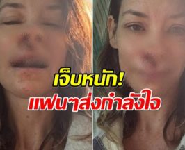 วูบกลางหาด! นักเเสดงสาว หน้าฟาดหิน แผลชัดจนแฟนตกใจ