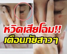 ซุปตาร์สาว เตือนภัยสายบิวตี้ หลังโดน มาส์กตาไอน้ำลวกจนผิวไหม้
