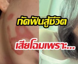 ดาราสาว เผยรอยแผลหน้าเสียโฉม ไม่ท้อสมัครงานหาเงินรักษา