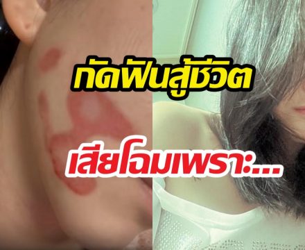 ดาราสาว เผยรอยแผลหน้าเสียโฉม ไม่ท้อสมัครงานหาเงินรักษา