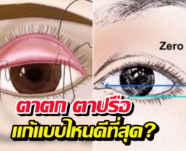 แก้ปัญหาตาตก ตาปรือ วิธีไหนดี ระหว่าง Subbrown Lift หรือ ทำตา2ชั้น