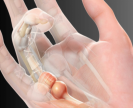 เช็กด่วน! คุณกำลังเสี่ยง โรคนิ้วล็อค อยู่หรือไม่?