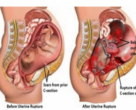 ทำความรู้จัก ภาวะมดลูกเเตก อันตรายทั้งเเม่เเละลูก