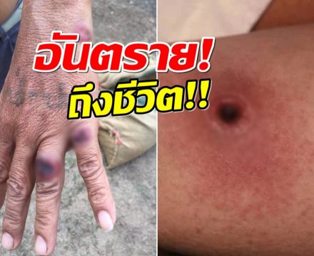 เช็คอาการ แอนแทรกซ์ โรคติดต่อจากสัตว์ ที่ไทยพบผู้เสียชีวิตเเล้ว